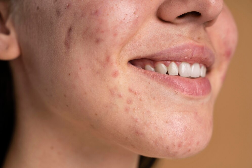 Skincare treatment